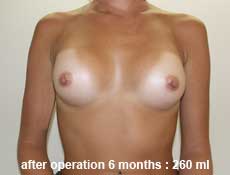 plastic-surgery-breast-augmentation 